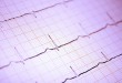 Irregular Heart Beat May Pose Bigger Threat to Women